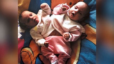 gabby garcia conjoined twin|Local former conjoined twin using TikTok to educate。